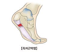 족저 근막염 증상
