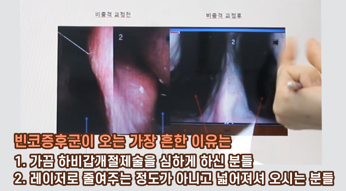 빈코증후군이 오는 가장 흔한 이유
