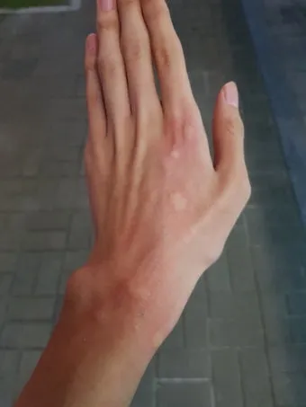 모기 물려 가려울 때 땀띠에 안티푸라민 연고 효능 부작용 사용후기_9