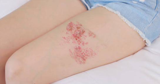 대상포진 증상, 전염, 치료방법 총정리 (2024ver)