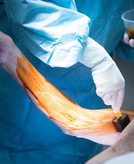 신경 이동술(전방 전위술): 척골 신경 압박 증후군 치료