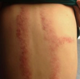 대상포진 증상 사진