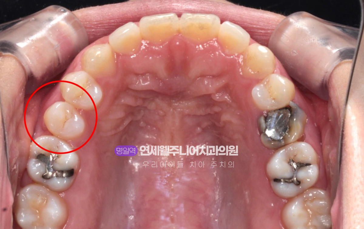 MTA 교정 후 회전된 작은어금니가 치열에 맞게 배열된 모습