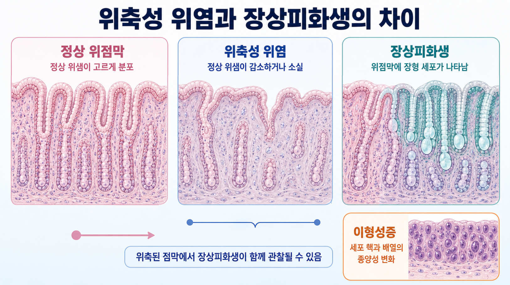 정상 위점막과 위축성 위염·장상피화생·이형성증의 조직 변화를 비교한 인포그래픽