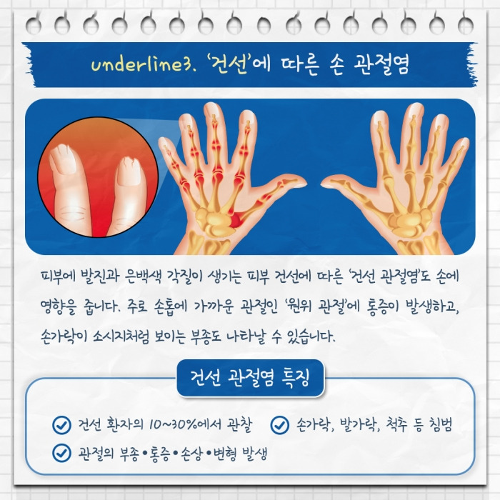 손가락 류마티스 관절염 주요 증상과 체크 리스트