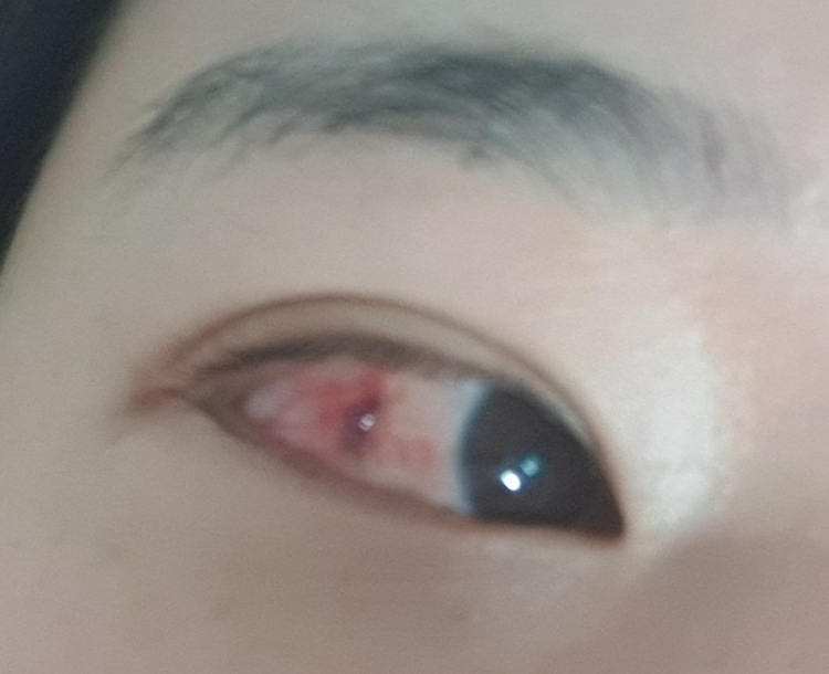눈 흰자 물집 치료 후 3일째