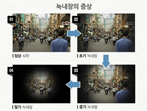 녹내장 증상