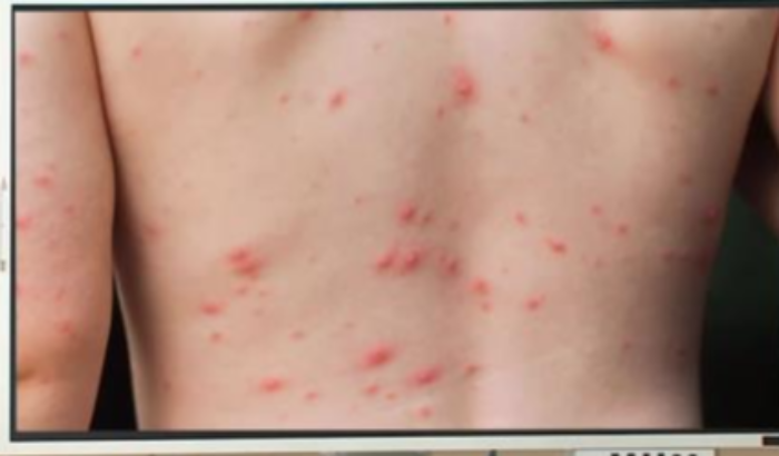 원숭이두창 발진