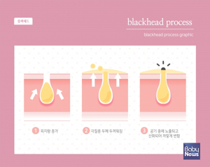 좁쌀 여드름 없애기