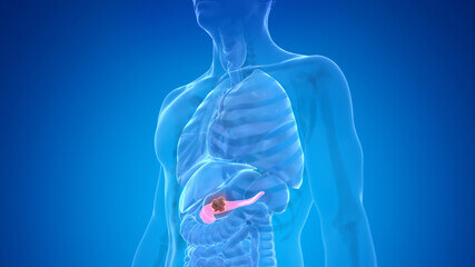 췌장암 원인 증상 진단 치료 수술