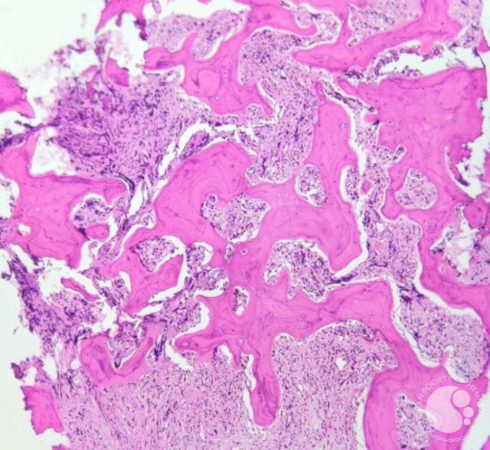 트라우마 유발 급성폐손상(TRALI)의 면역학적 기전