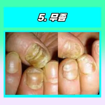 손톱이 갈라지는 이유 원인 증상 대처법_17