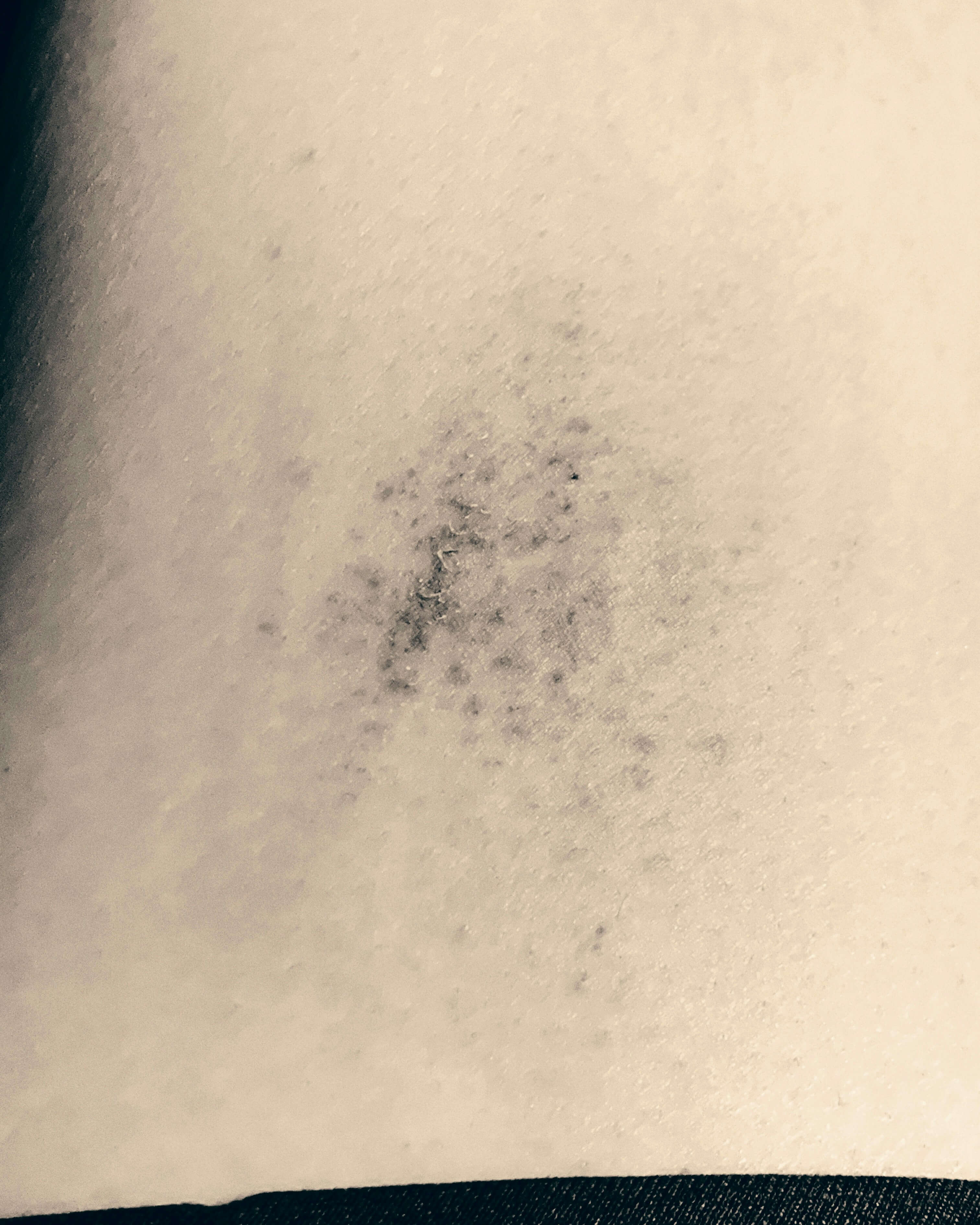 피부 시술 후 관리 - 멍과 붓기를 빠르게 완화하는 회복 구조 이해