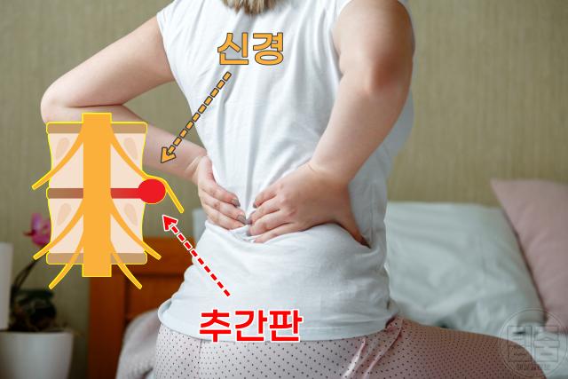 허리디스크 추간판탈출증 전조증상