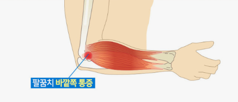 팔꿈치바깥쪽통증
