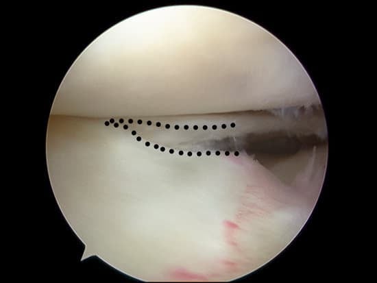 반월상 연골 파열