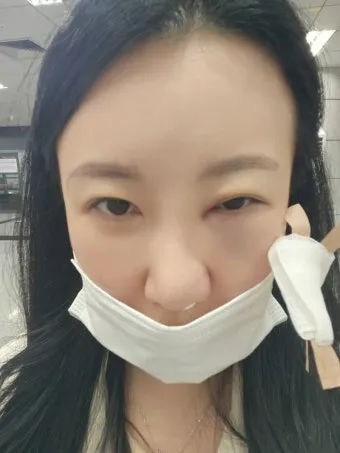 눈물샘 뚫는 수술 간단한가요에 대한 수술정보_17