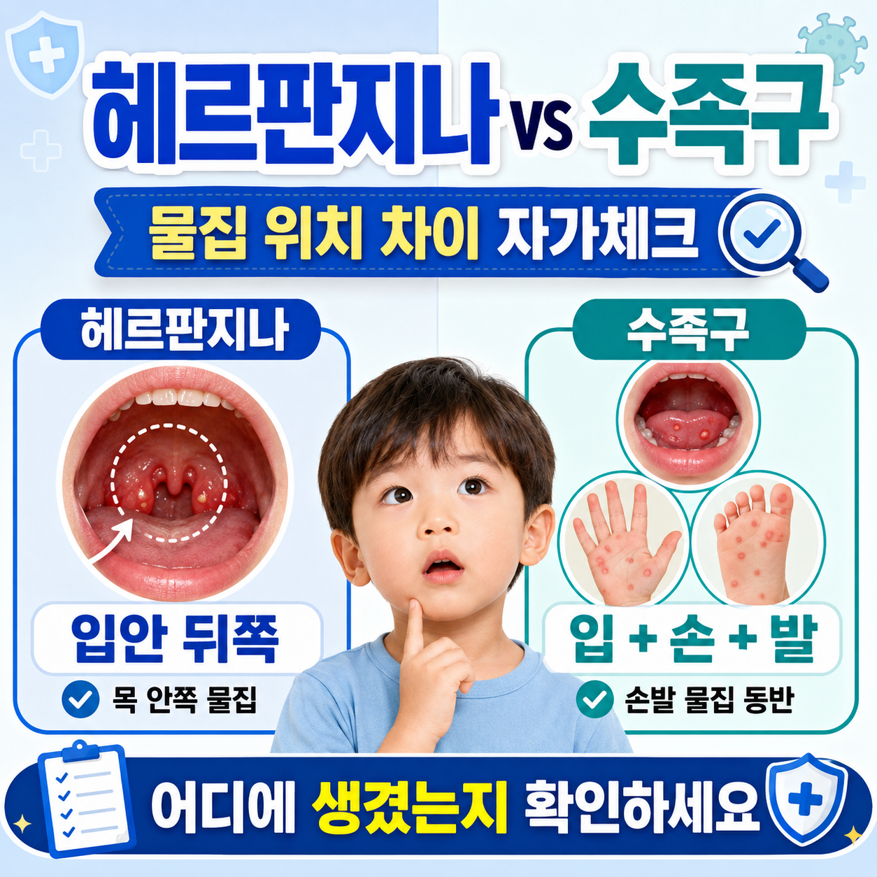 헤르판지나와 수족구 물집 위치 차이 자가체크 안내