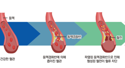 콜레스테롤 이미지