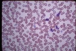 혈소판 수치가 낮으면