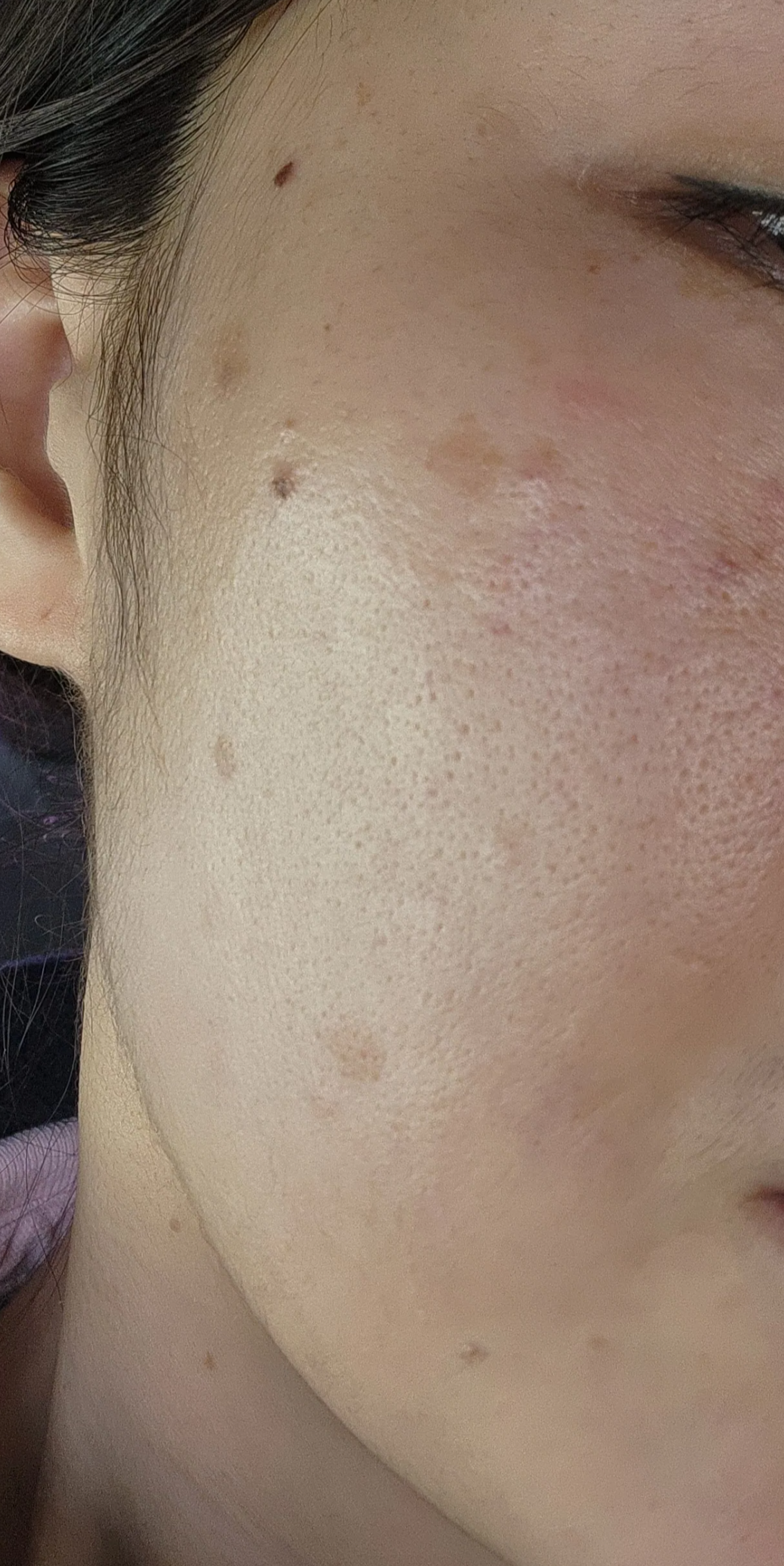 흑자 엑셀V시술 직후 왼쪽사진 부풀어오름