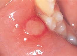 입안이 자주 허는 이유