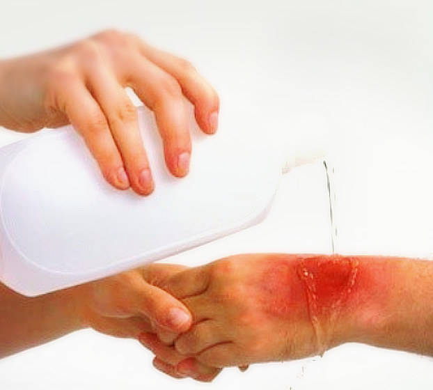 손에 화상을 입어 물로 헹구고 있다