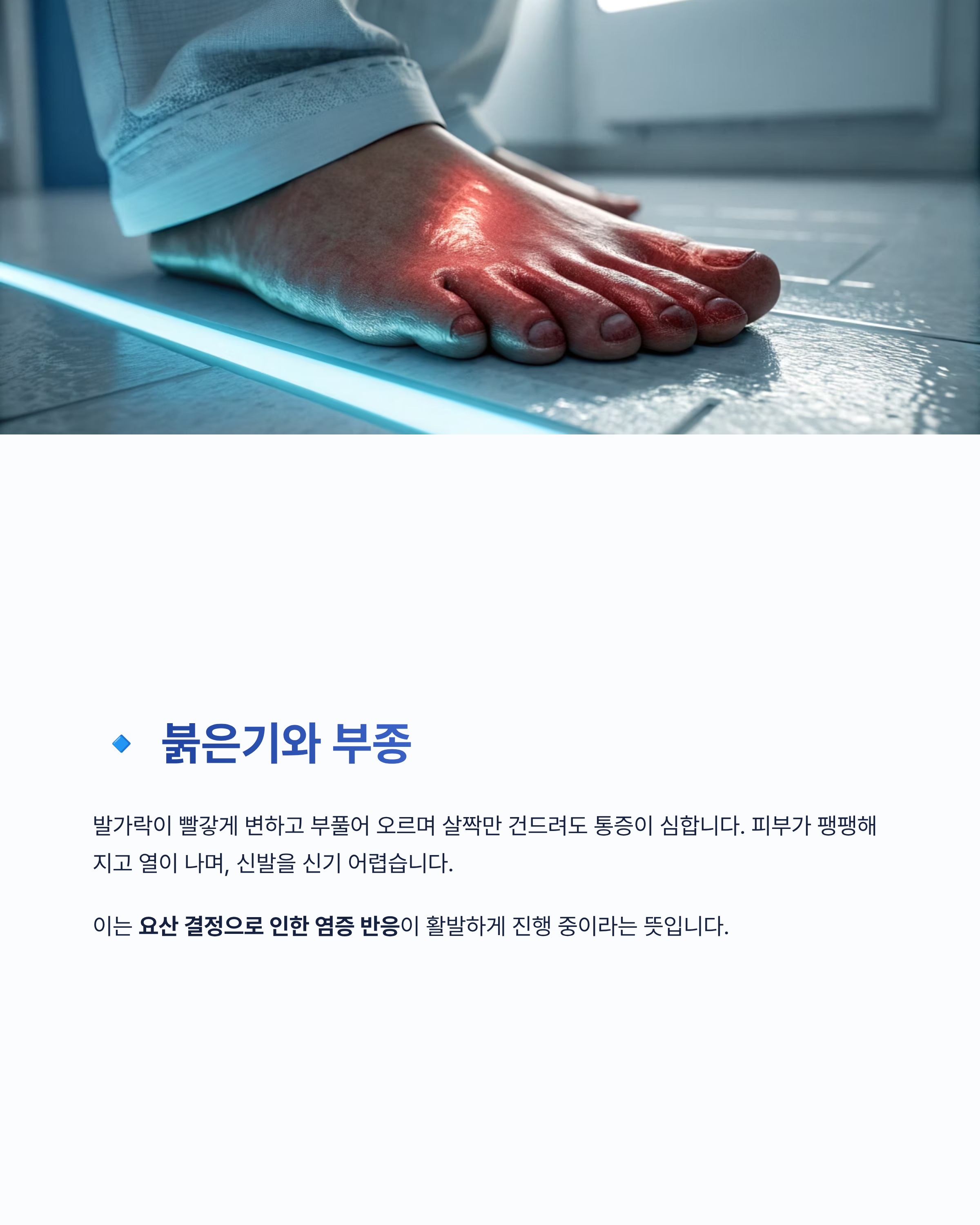 발가락 통풍완전초기증상 알아보기