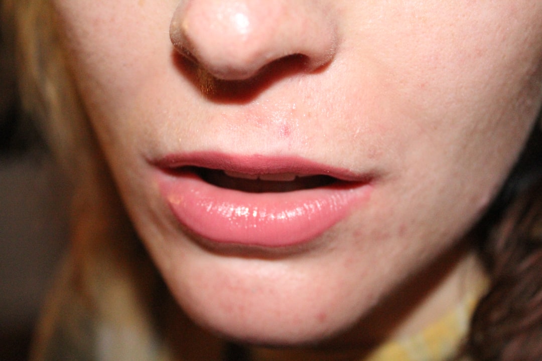 Acne