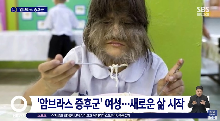 다모증에 대한 여성의 변화