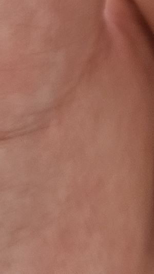 수족구병 증상 격리기간