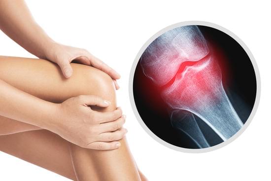 골관절염 (Osteoarthritis): 원인, 증상, 치료 및 관리