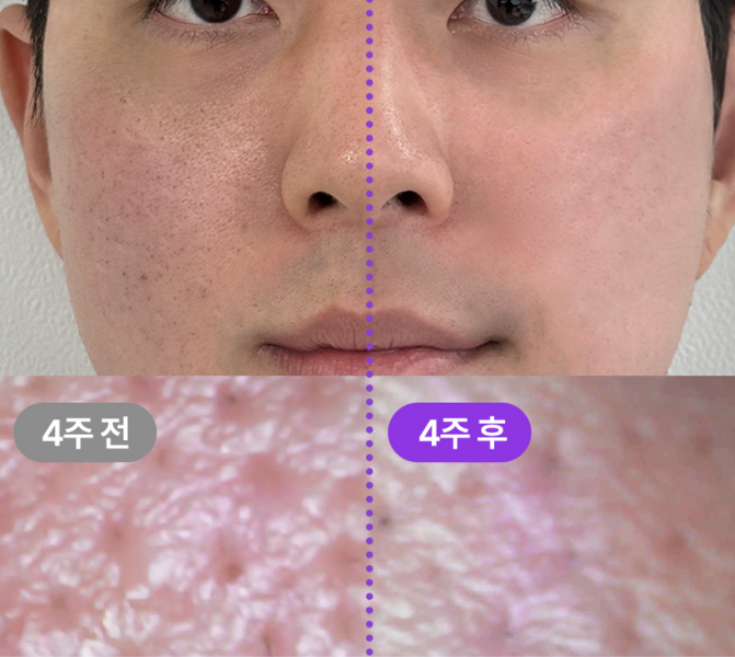 식스킨 타이트샷 사용 전과 사용 후 비교 사진 남자