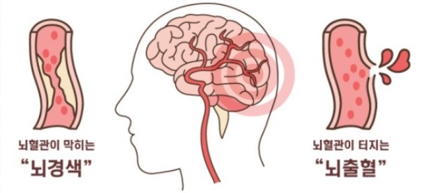 뇌졸중 뇌경색과 뇌출혈