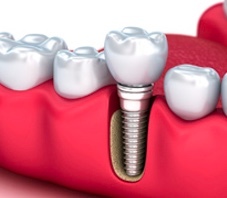 전체임플란트잘하는곳-전체임플란트치과고르는법-전체임플란트가격-시술후기