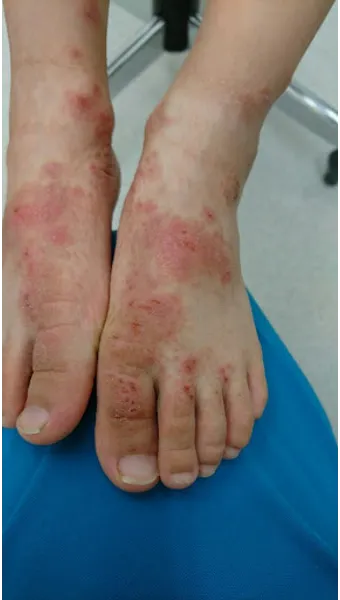 에로콤크림 코르티코이드 반응성 피부질환에서의 염증가려움 완화 전략에 대한 사용수칙_6