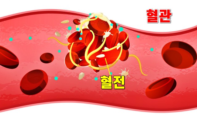 혈전 생기면 나타나는 증상 7, 혈전 증상, 혈전이란?