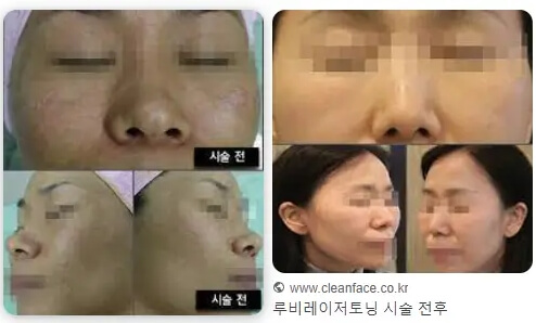 루비레이저
