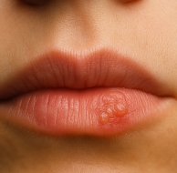 입술에 물집이 생기는 이유