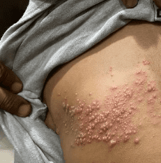 대상포진 예방접종 가격