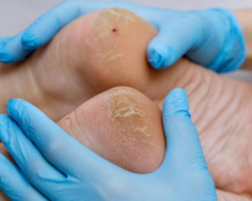 발뒤꿈치 갈라진 모습