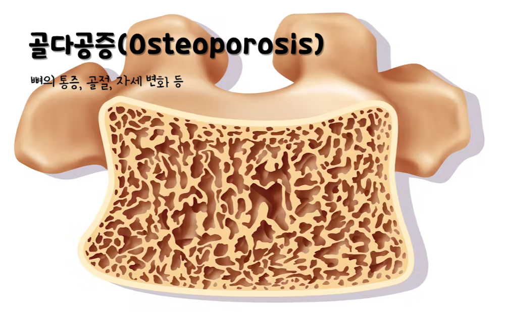 골다공증(Osteoporosis)
골다공증의 주요 증상 : 뼈의 통증, 골절, 자세 변화 등