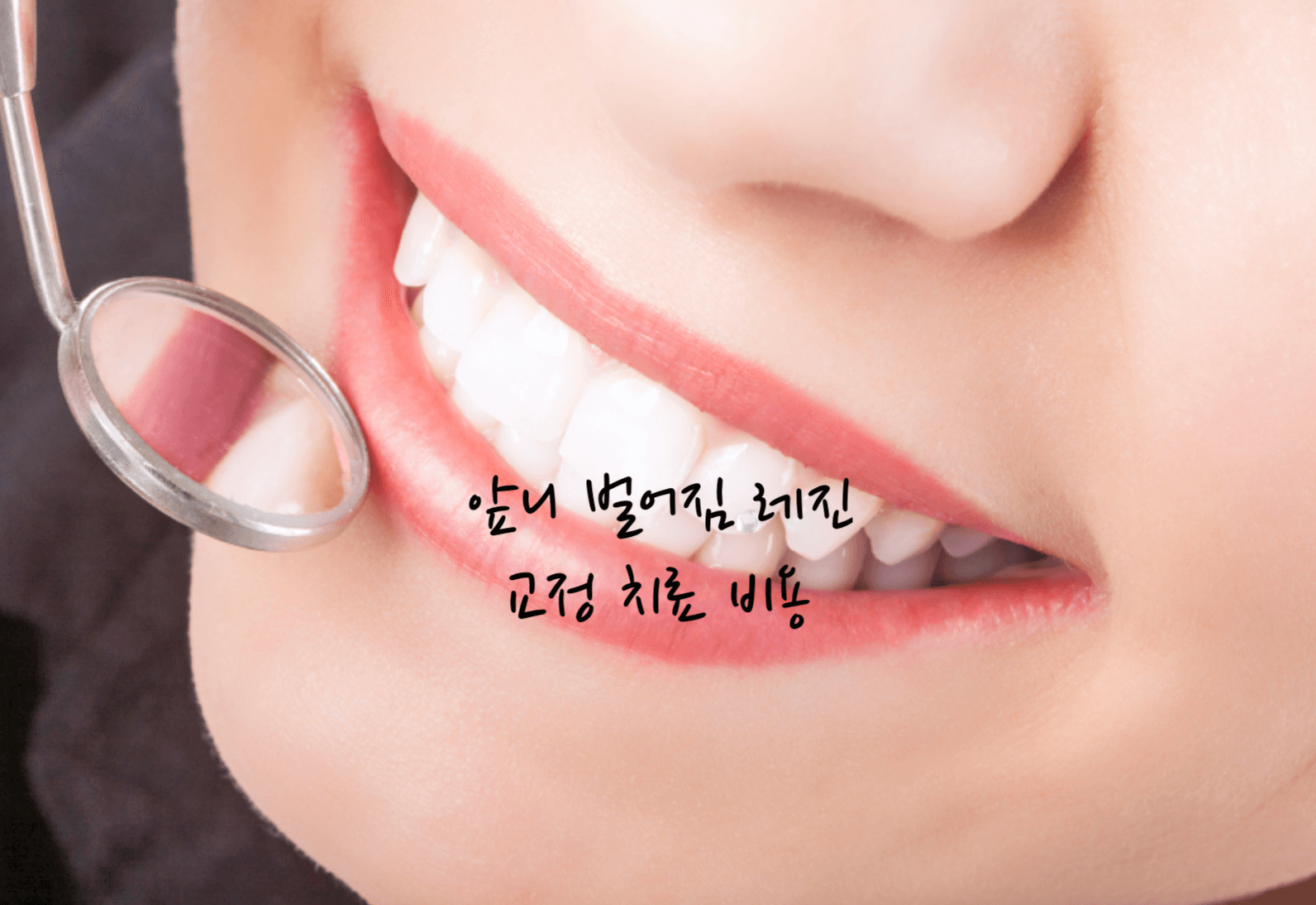 앞니 벌어짐 레진