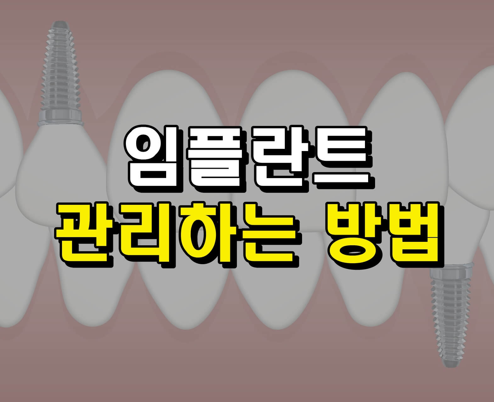 치아에 박혀있는 임플란트