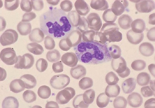 골수형성이상증후군 증상 및 진단기준