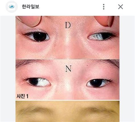 성인 사시 수술