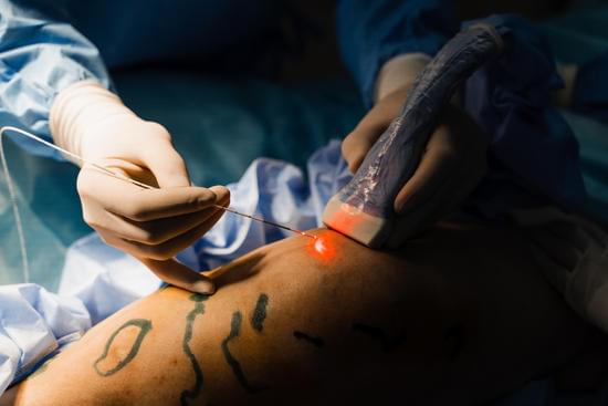 레이저 정맥 제거술(Endovenous Laser Treatment, EVLT)