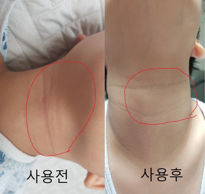 바이오덤아토하이드로겔 사용 전 후 사진