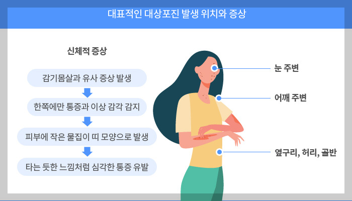 대상포진 발생위치 증상