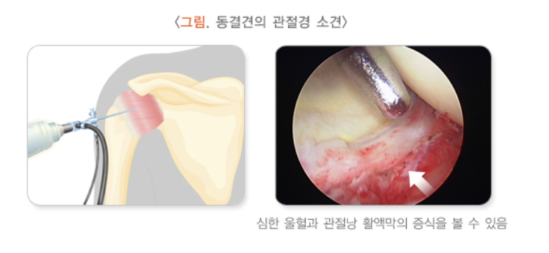 오십견 수술